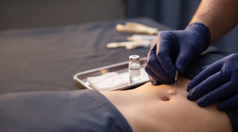 Nöralterapi uygulaması — lokal anestezikle yüzeyel enjeksiyon